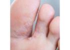 Fast Relief for Athlete's Foot and Fungal Infections