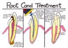 Root Canal Specialist in Lewisville,TX