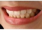 Best-in-class porcelain veneers service in Lewisville.