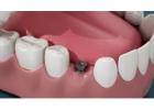 Siiodent Implants: Your Trusted Source for Bulk Dental Implants