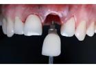 Siiodent Implants: Excellence in Dental Implant Manufacturing