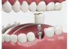 Siiodent Implants – Precision Multi-Unit Abutment for Hex Implant Angled