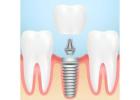 Innovating the Future – Dental Implant Research and Development | Siiodent Implants