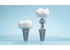 Siiodent Implants: Your Source for Wholesale Dental Implants