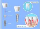 Siiodent Implants: CMI Conical Micro Straight Implant