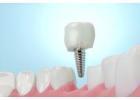 Siiodent Implants – Precision Angled Abutment for Conical Implant Restorations