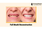 Teeth Reconstruction for Complete Smile Restoration | Dr. Anurag Bhargava