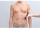 Abdominoplasty in Islamabad
