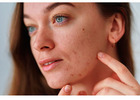 Dermatologist Orlando | Allergy & Asthma Center | Skin check, Acne, Skin Cancer, Moles