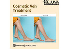 Cosmetic Vein Treatment in Newport Beach for Clearer Skin