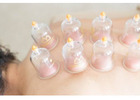 Cupping Therapy NYC | Expert Cupping Services in New York City