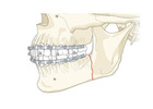 Jaw Surgery in Indore | Dr. Anurag Bhargava