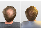 Hair Loss Solutions Dallas | Women’s Thinning Hair Specialist