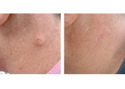 Cyst Removal Harley Street – Professional Dermatology Care in London