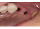 All-on-4 Dental Implants in Tijuana, Mexico – Affordable, Life-Changing Results!