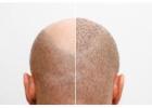 Best Hair Transplant Treatment